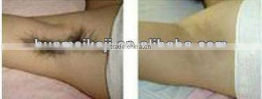 diode laser hair epilator handsets