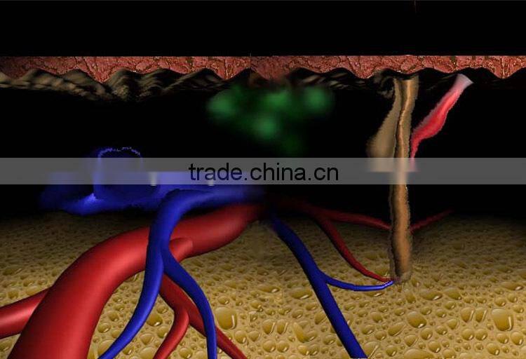 hair removal beauty 808nm soprano laser plastic epilator machine