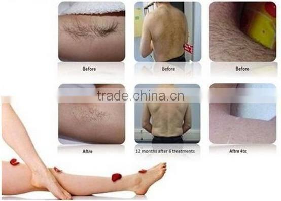 Newest mode portable diode laser hair removal professional 808nm diode laser hair removal machine