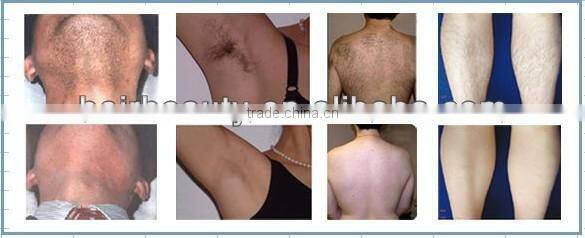 Professional SHR hair removal e-light ipl hair removal machine