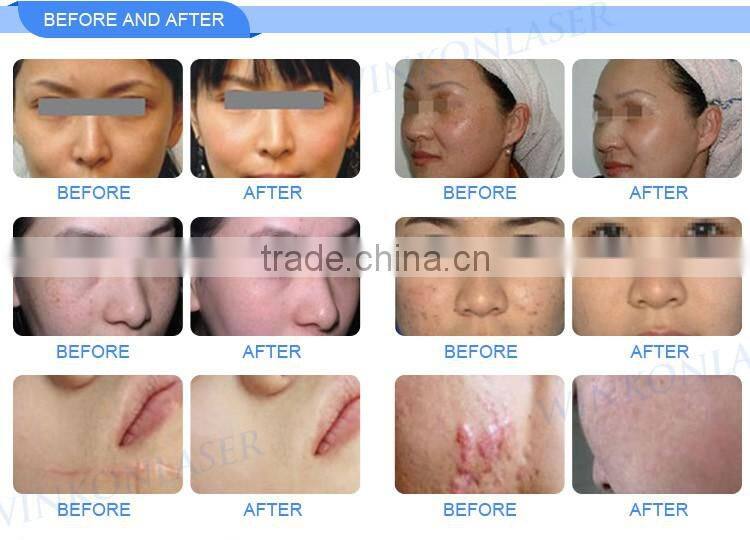 OE FDA approved 30W Generator Vaginal Tightening machine with imported CO2 laser tube