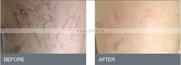 remove vascular skin recovery surgical vein removal instrument