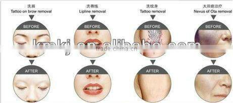 Hot selling 5 in 1 ipl/rf/tattoo removal laser