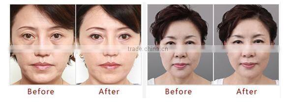 # portable radio frequency rf wrinkle removal machine