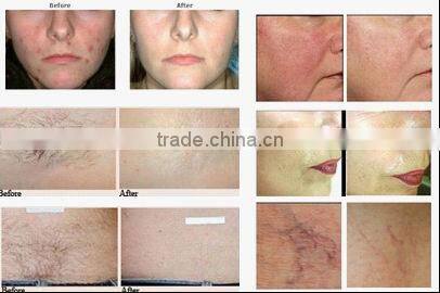 2 colors for choose GI-14 portable one crystal hand IPL hair removal and skin care