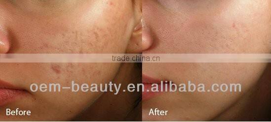 China hot-selling mesotherapy needle machine