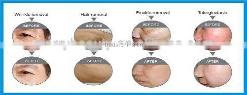 Best selling products E-light hair removal machine