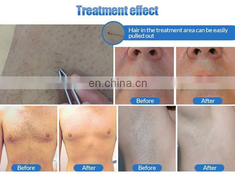 2020 most popular pigmentation removal skin tightening e-light 808nm nd yag laser multifunction machine