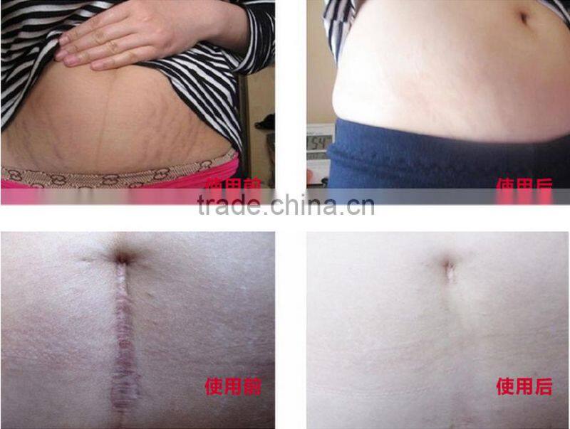 Stretch marks cream,postpartum obesity , pregnancy repairing cream, slack line,dsmv a potent repair scar products