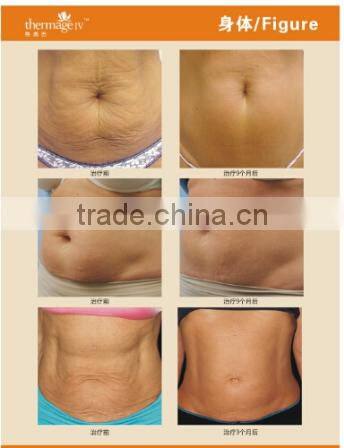 AYJ-C19(CE) Dot matrix portable rf thermagic galvanic facial machine