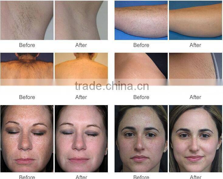 Best choice for beauty salon device White SHR(super hair removal) and IPL beauty handle