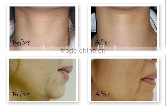 2016 best selling products micro needle pen 540 microneedle derma roller / facial and skin derma rollers skin care