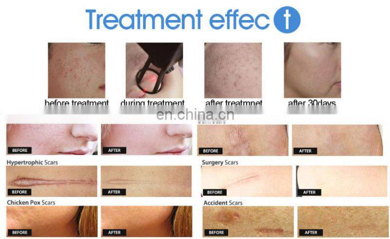 Salon Clinic Equipment Co2 Fractional Laser