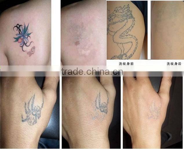 nd:yag Q switched laser for tattoo removal