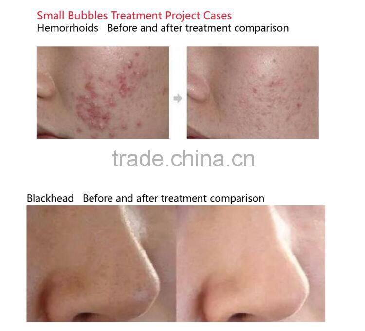 Improve Skin Texture Skin Whitening Beauty Machine with High Quality