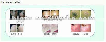 popular multi-functional beauty instrument(IPL+RF+nd yag laser)for hair removal,skin rejuvenation,laser tattoo removal