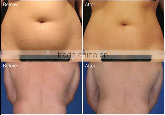 5in1 tri polar RF multipolar RF vacuum ultrasound cavitation slimming equipment