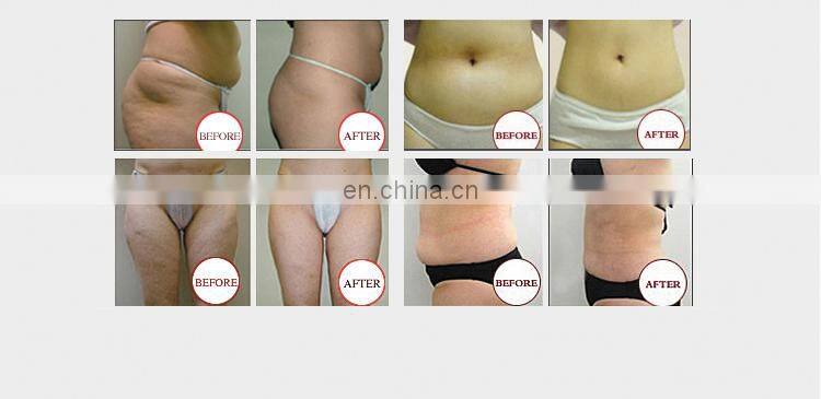 Factory price cryo 21 machine with double chin removal handles