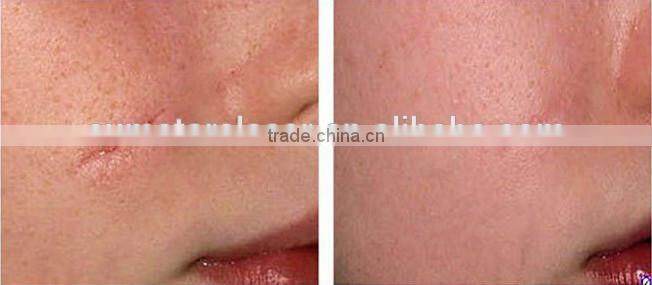 co2 fractional laser machine , co2 laser power supply/ Machines of fractional co2 laser