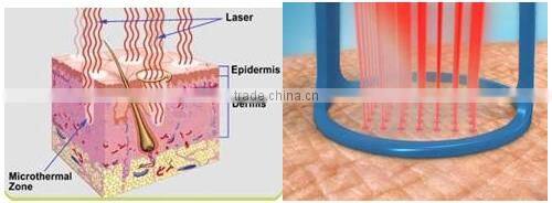 Hottest sale vaginal rejuvenation laser fractional co2 laser machine