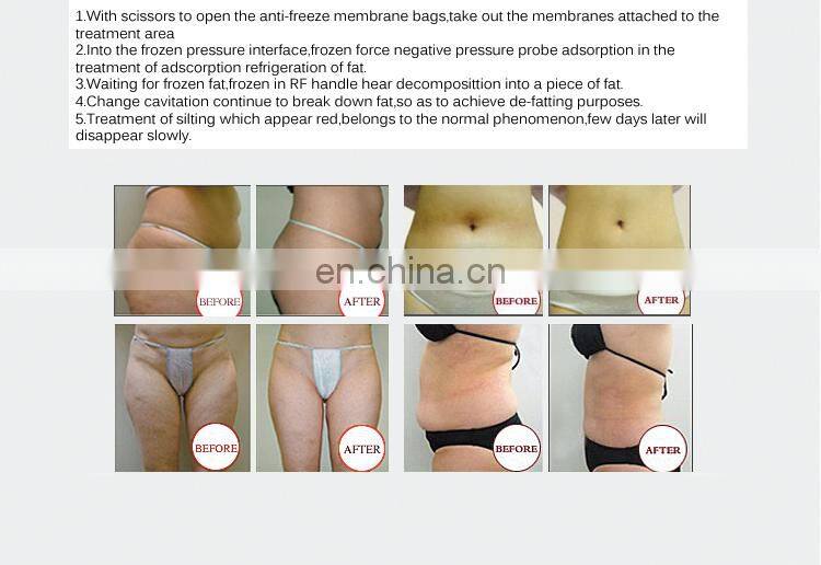 Double chin fat removal criolipolisis machine cryolipolysis 5 handles cryolipolysis