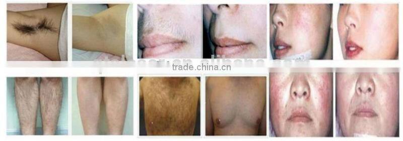 RF E-light nd yag laser nd yag laser hair removal machine