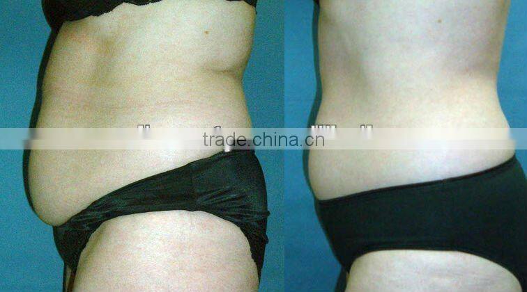 Ultrasonic Cavitation & rf slimming machine for beauty salon - F017