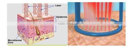 medical technology co2 laser fractional rf vaginal tightening equipment