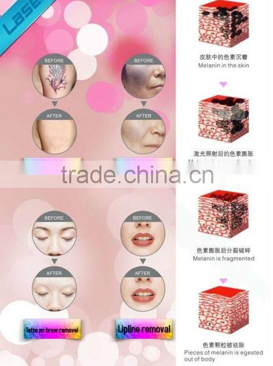 Multifunctional Nd-Yag Laser Tattoo Removal Machine Price for Black Doll Treatment