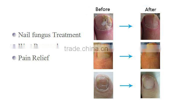 High quality Fungal Infection 1064nm Toenail long pulse laser in usa