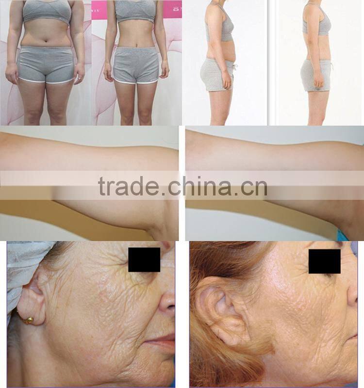 2015 best Laser fat removal slimming mini portable ultrasound machines