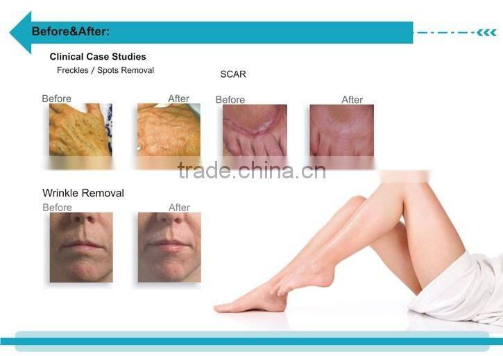 Protable Scanner Fractional 10W RF tube Co2 laser vaginal tightening beauty Equipment/Scanning Fractional CO2 laser machine