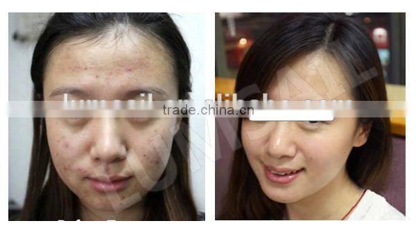 2014 New Arrival photo dynamic therapy pdt