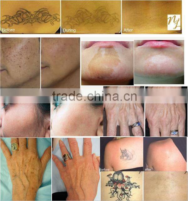 Popular Wholesale Price Q Switch Nd Yag Laser color Tattoo Removing Machine