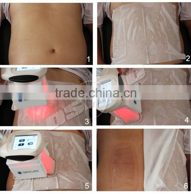 Cryolipolysis Slimming Machine 4 Handles Cryotherapy