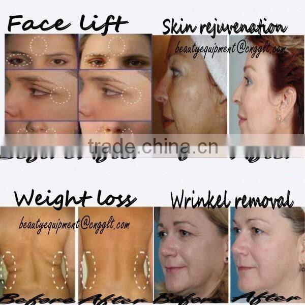 Multifunction 4 in 1 hair removal ipl elight nd yag laser aesthetics
