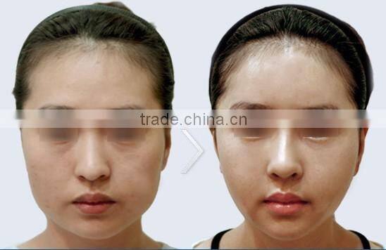 Factory direct selling Low price RF machine skin tightening face lifting ZOEY