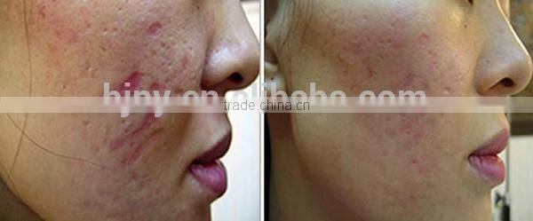 Factory Direct Sale Facial Derma Stamp With 40 Micro Needles