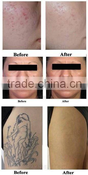 PROFESSIONAL Q SWITCH YAG LASER TATTOO EYEBROW CALLUS REMOVAL / LASER TATOO REMOVER