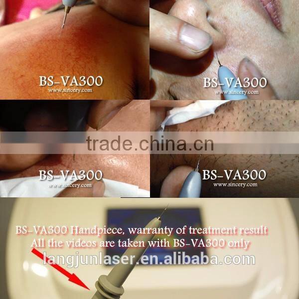 Beautiful Professional Cure Telangiectasia Treatment Vein Removal Equipment