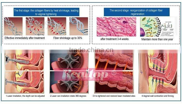 Non-invasive newest sex vagin tighening technology female private parts care,high intensity focused ultrasound hifu to tighten