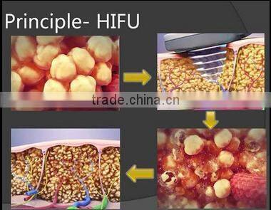 distributor wanted!!Sanhe New Products hifu machine 33mm-63mm fat reduce hifushape hifu slimming fat reduce machine