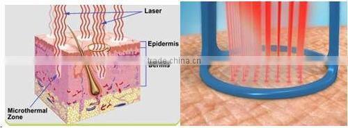best price fractional/fractionated CO2 laser 10600nm fractionated CO2RE CO2 laser