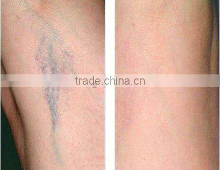 Portable Intense Pulsed Light IPL Acne/Hair Removal Device