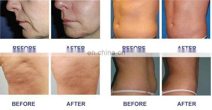 Osano V10 velashape vacuum massage sculptor body lipo vacuum osana v10 velashape