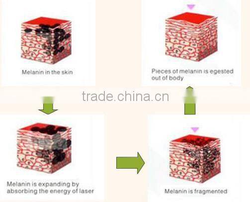 HOT! 2016 most popular mini laser removal tattoo machine