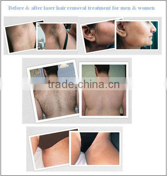 Comfortable cooling probe Beauty equipment FB-P001-Long pluse laser machine for hair removal/spider veins removal