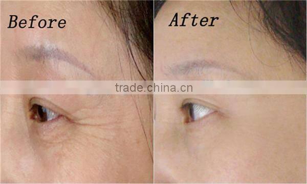 3d face lift removing eye bags machines