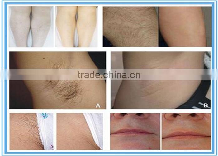 2016 new design ipl shr hair removal machine