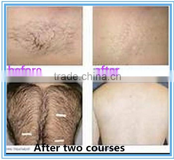 latest technology professional painless 808nm diode laser hair removal machine